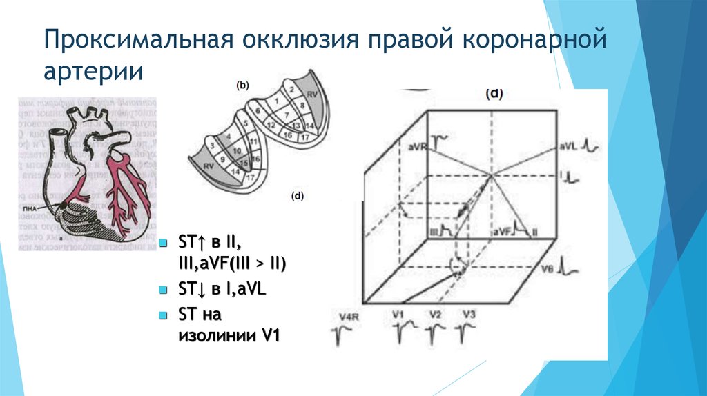 Коронарная окклюзия. Субоклюзия правой коронарн. Проксимальная окклюзия. А И окклюзия проксимального сегмента. Окклюзия проксимального отдела.