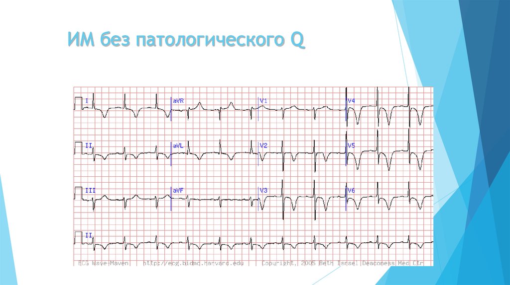 Патологии экг презентация