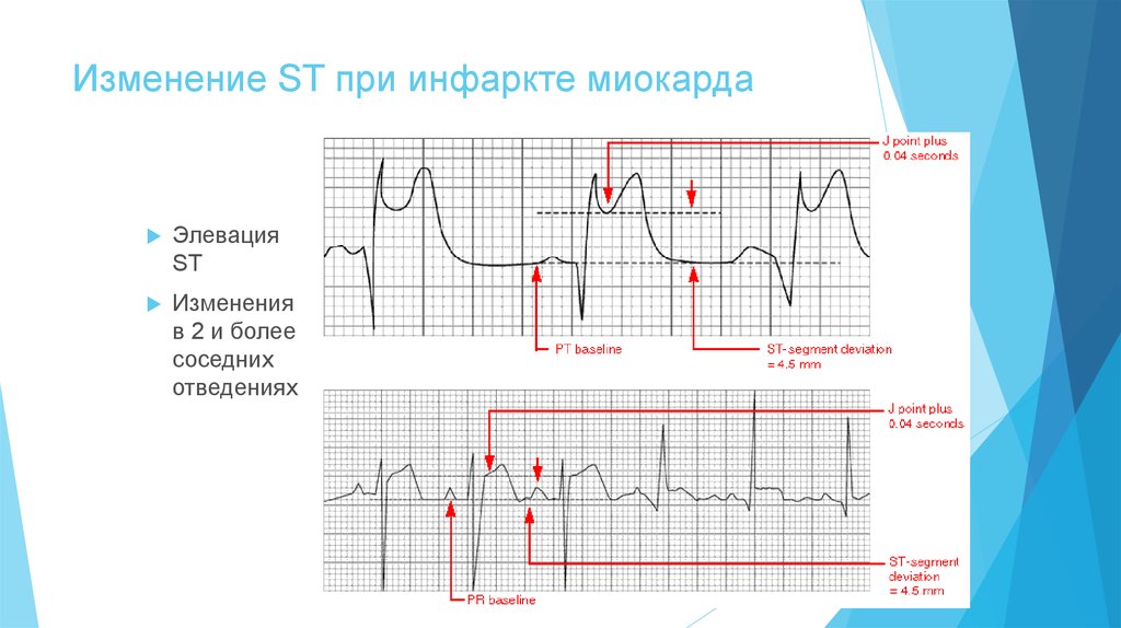 Патологический зубец q при инфаркте. Зубец q после инфаркта миокарда. Локализация инфаркта на ЭКГ. Изменения на ЭКГ при перенесенном инфаркте миокарда. Изменения на ЭКГ после перенесенного инфаркта миокарда.