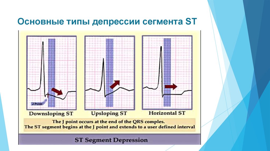 Эпизод депрессии st. Депрессия сегмента St на ЭКГ v5 v6. Депрессия сегмента ст в v6. Косонисходящая депрессия сегмента St. Депрессия сегмента St косонисходящего типа.
