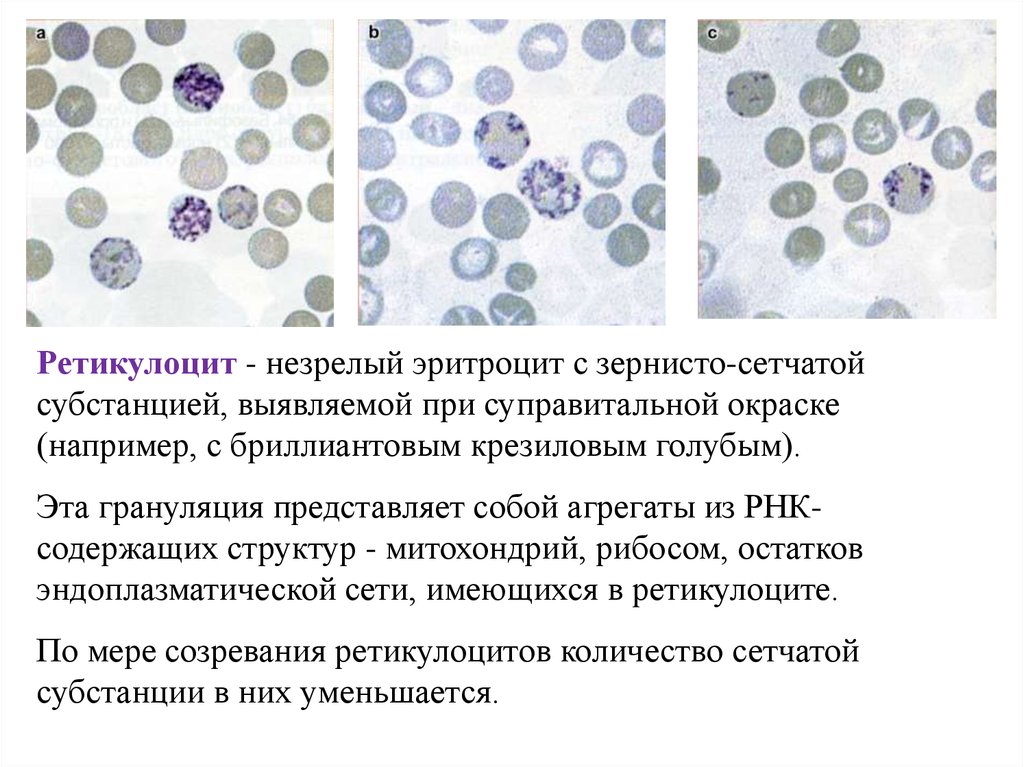 Морфология эритроцитов в мазке крови. Ретикулоциты в мазке крови фото. Бриллиантовый крезиловый синий для окраски ретикулоцитов в крови. Мазок крови человека рисунок с обозначениями.