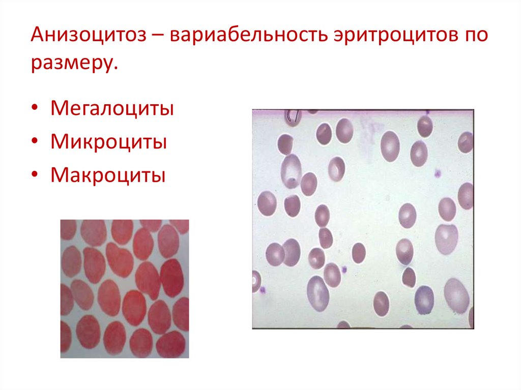 Размер эритроцита. Анизоцитоз пойкилоцитоз полихроматофилия. Анизоцитоз анемия. Анизоцитоз эритроцитов. Микроцитоз анизоцитоз пойкилоцитоз.