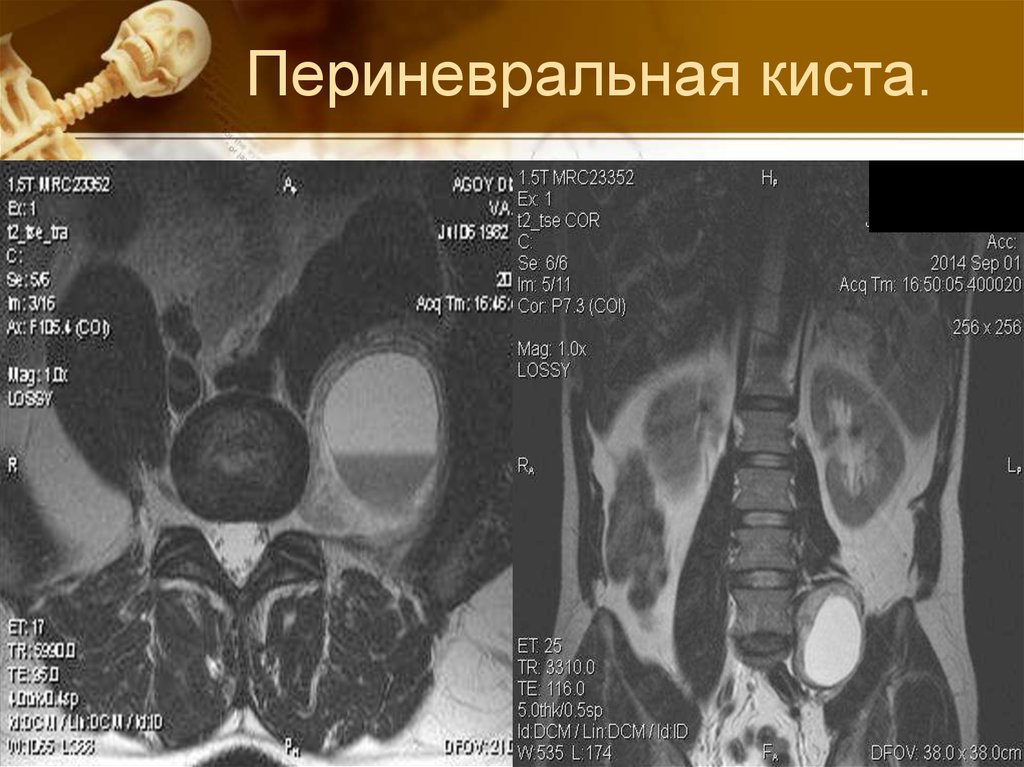 Периневральная киста. Периневральные кисты s1-s3. Периневральная ликворная киста s2. Периневральная Сакральная ликворная киста позвоночника.