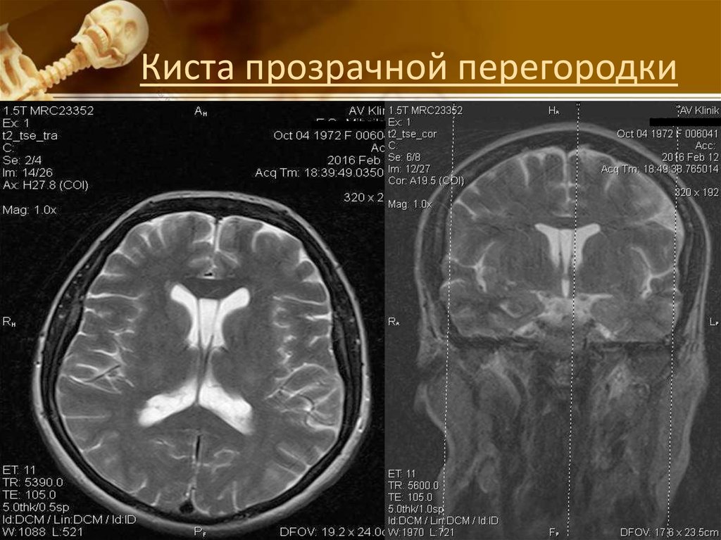 Прозрачная перегородка мозга. Киста прозрачной перегородки головного мозга кт. Киста Верге на кт. Киста прозрачной перегородки полость Верге мрт. Полость Верге мрт.