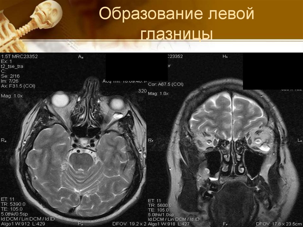 Образование левой. Образования глазницы мрт. Деструктивное образование глазницы.