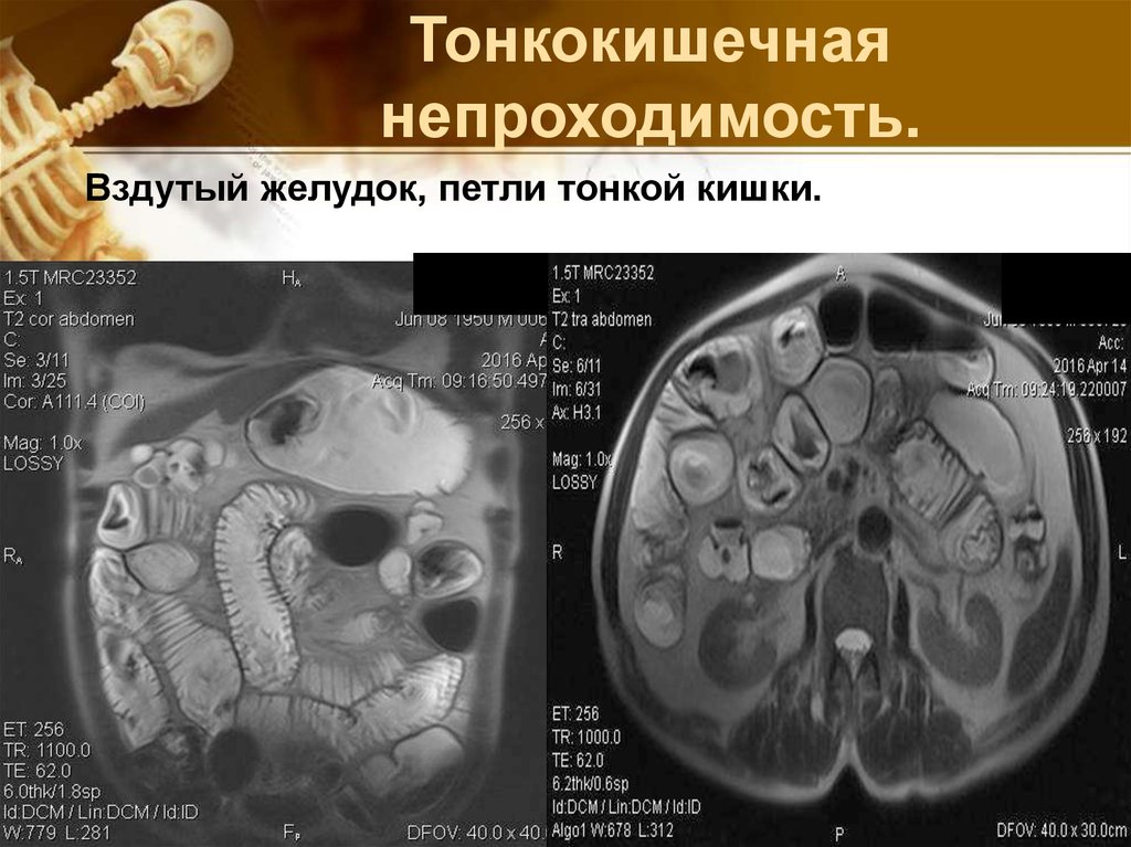 Тонкокишечная непроходимость