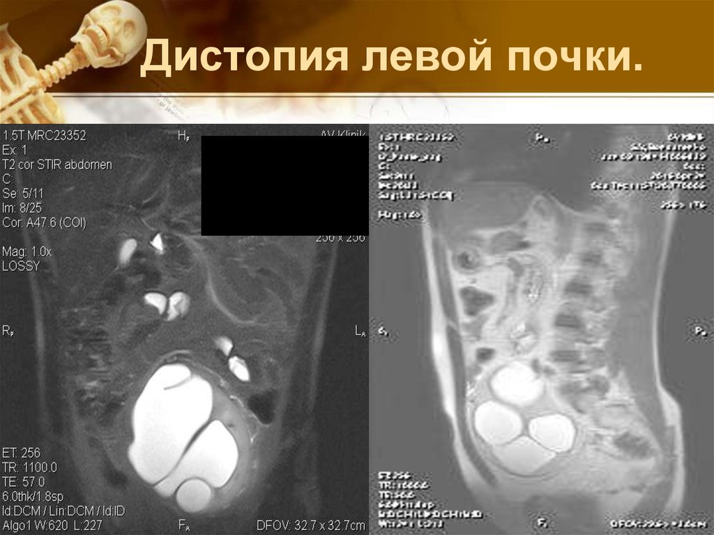 Дистопия почки. Атипичное расположение почки. Дистопия правой почки мрт. Дистопия почки клиника.