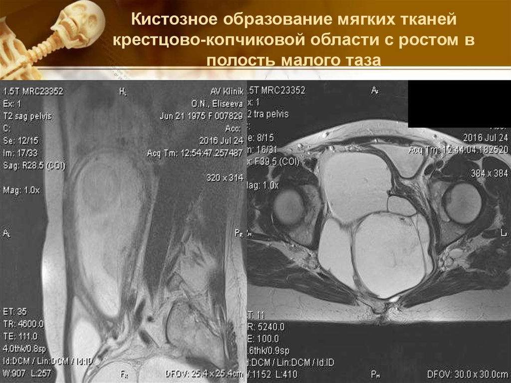 Образование в малом тазу у женщин. Кистозное образование малого таза. Кистозное образование мягких тканей. Кистообразное образование в Малом тазу. Кистозные образования малого таза на мрт.