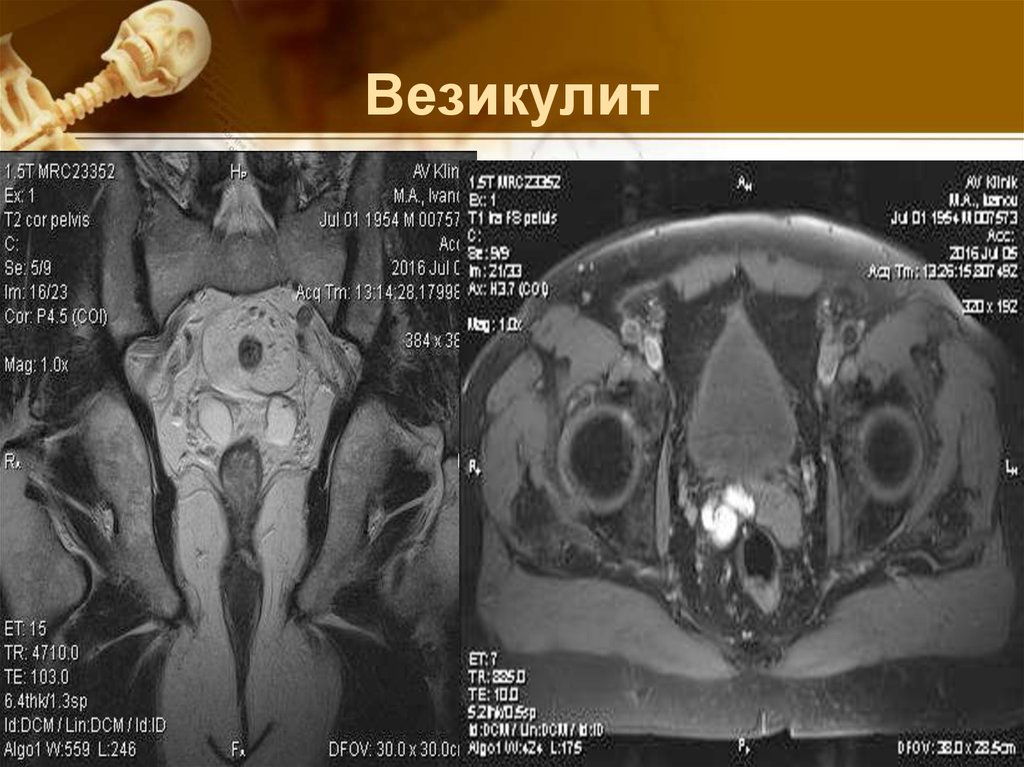 Воспаление семенных пузырьков схема лечения