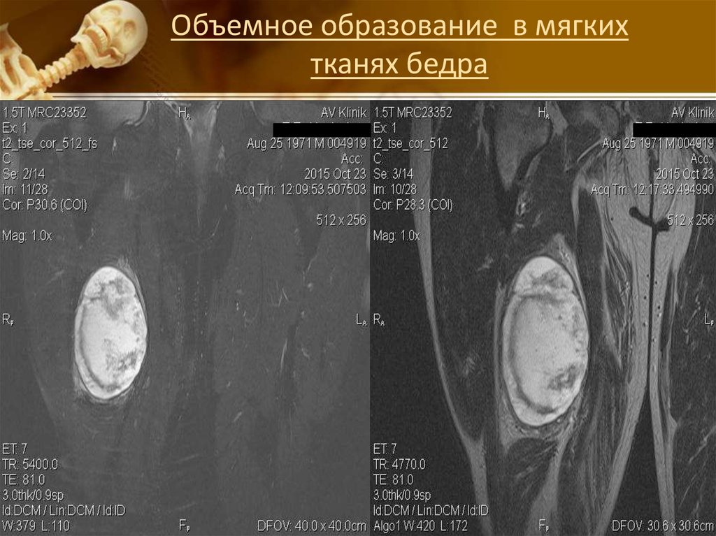 Образование мягких тканей. Объемное образование мягких тканей. Образование мягких тканей бедра. Образования мягких тканей бедра мрт. Кистозное образование мягких тканей.