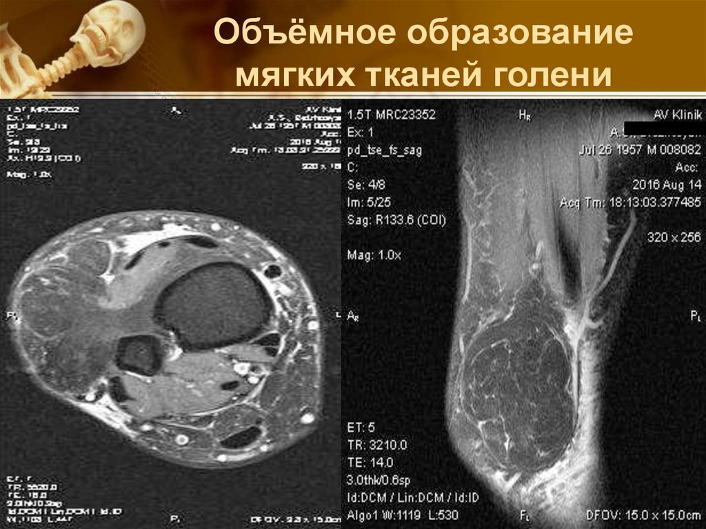 Объемное образование. Образования в мягких тканях голени. Объемное образование мягких тканей. Образование мягких тканей голени кт. Образование мягких тканей бедра.