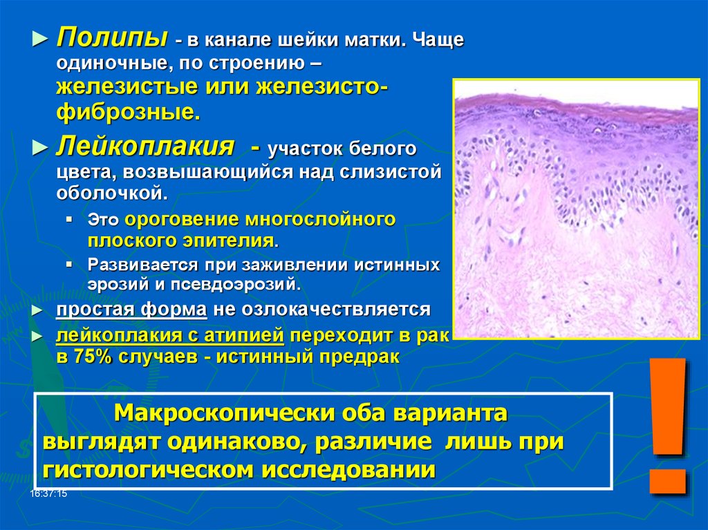 Дисплазия лейкоплакия эритроплакия. Лейкоплакия плоского эпителия. Лейкоплакия и эритроплакия шейки матки.