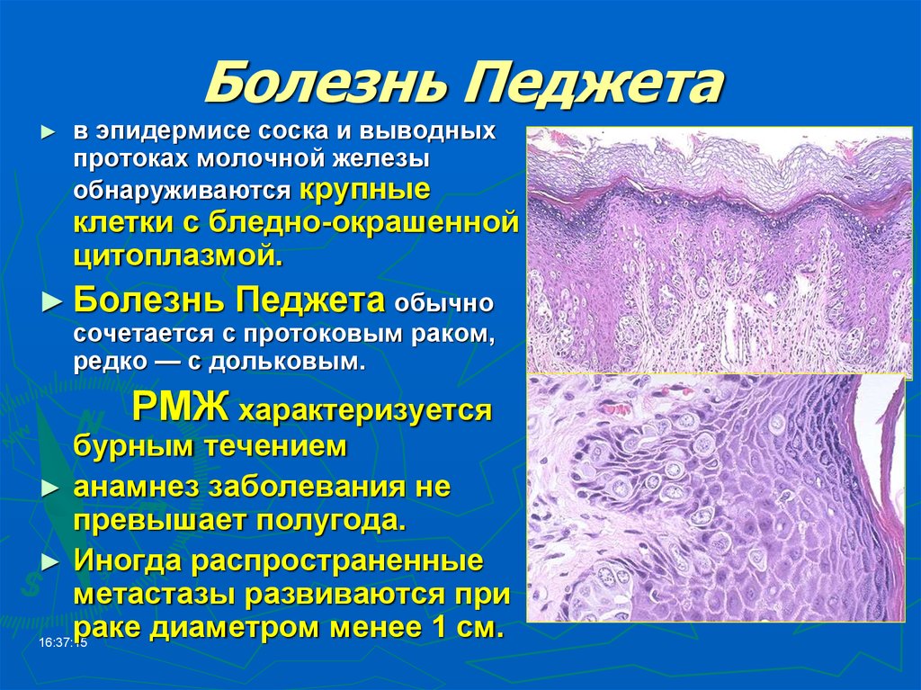 Болезнь педжета презентация