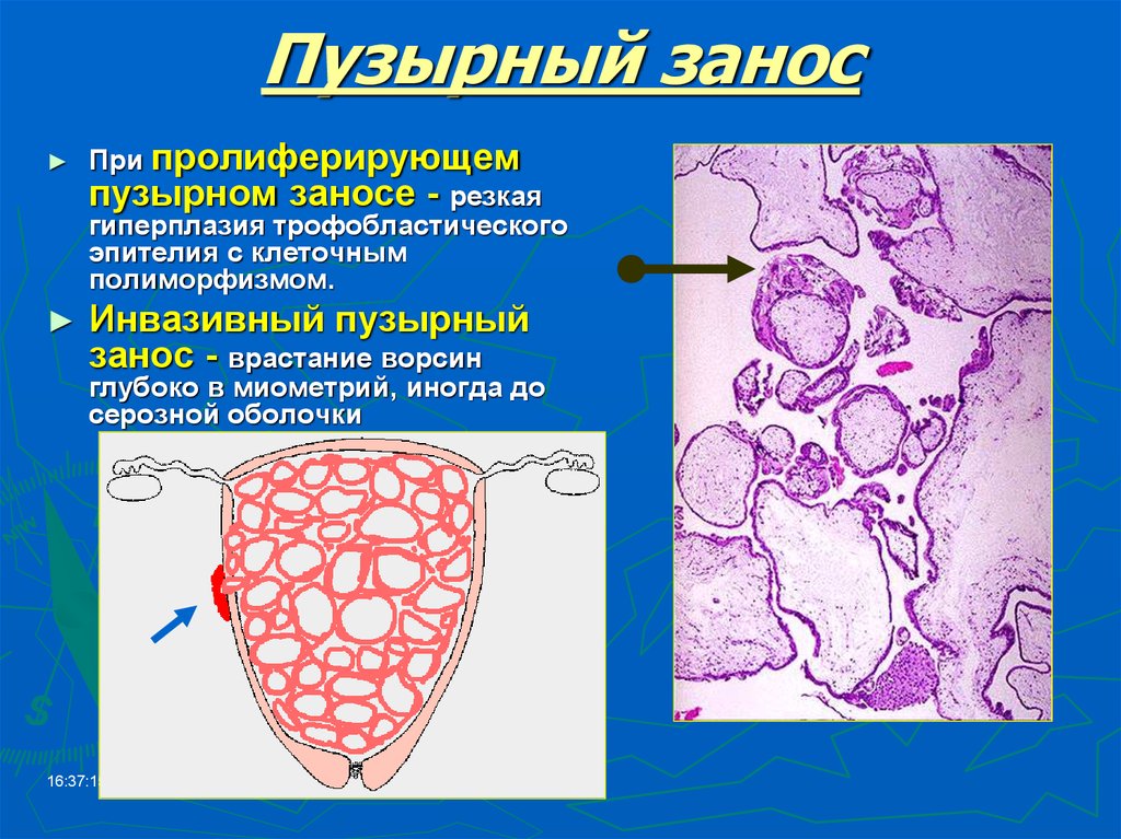 Трубная беременность микропрепарат рисунок