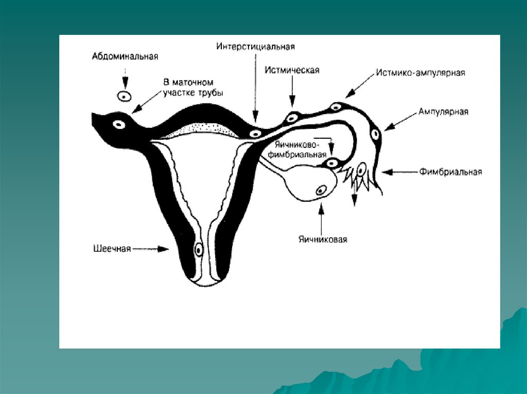 Фаллопиевы трубы. Интерстициальный отдел маточной трубы. Истмический отдел маточной трубы.