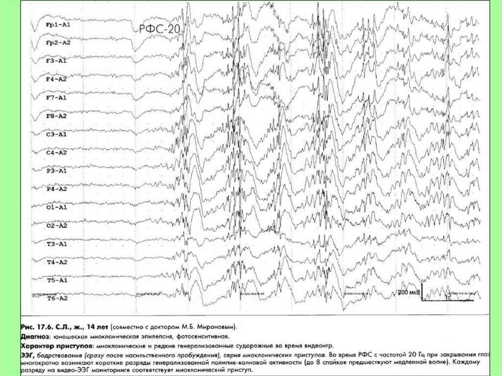Ээг при эпилепсии. Миоклонический приступ на ЭЭГ. ЭЭГ при миоклоническом приступе. Юношеская миоклоническая эпилепсия ЭЭГ. ЭЭГ ювенильная миоклоническая эпилепсия.
