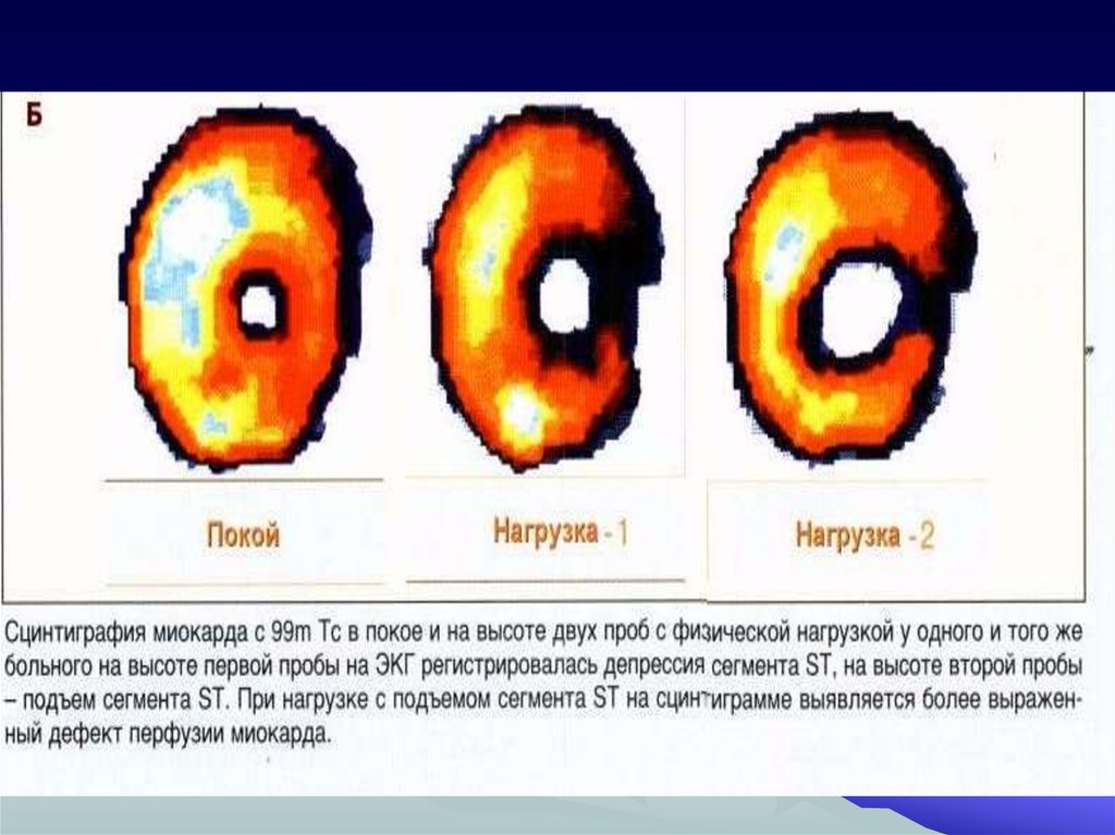 Презентация сцинтиграфия миокарда