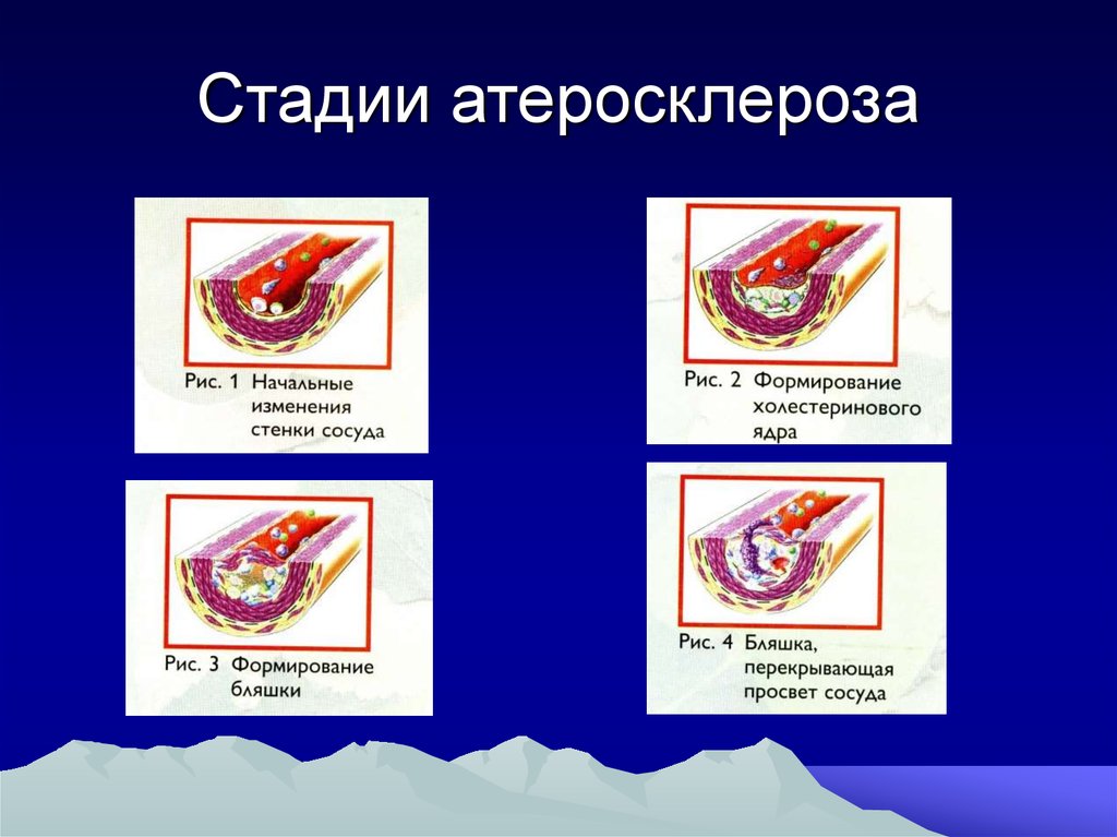 Атеросклероз патанатомия презентация