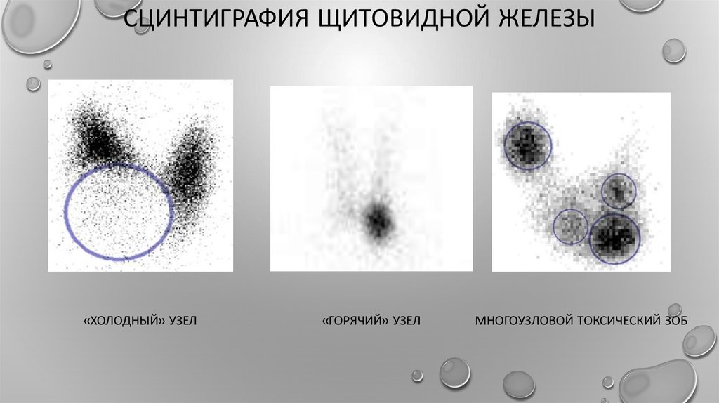 Сцинтиграфия щитовидной железы это