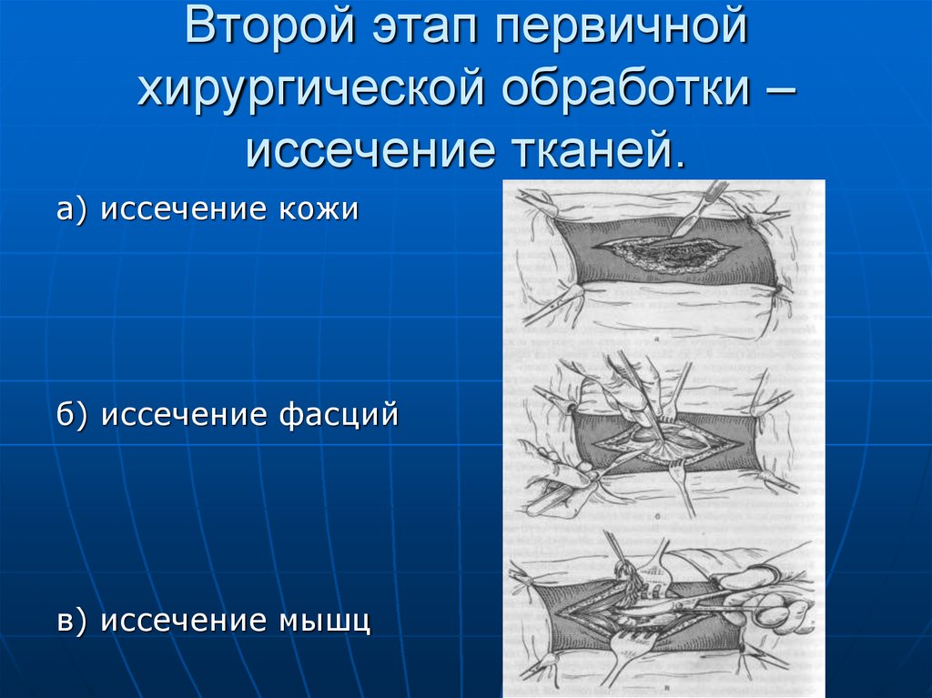 Обработка ран презентация