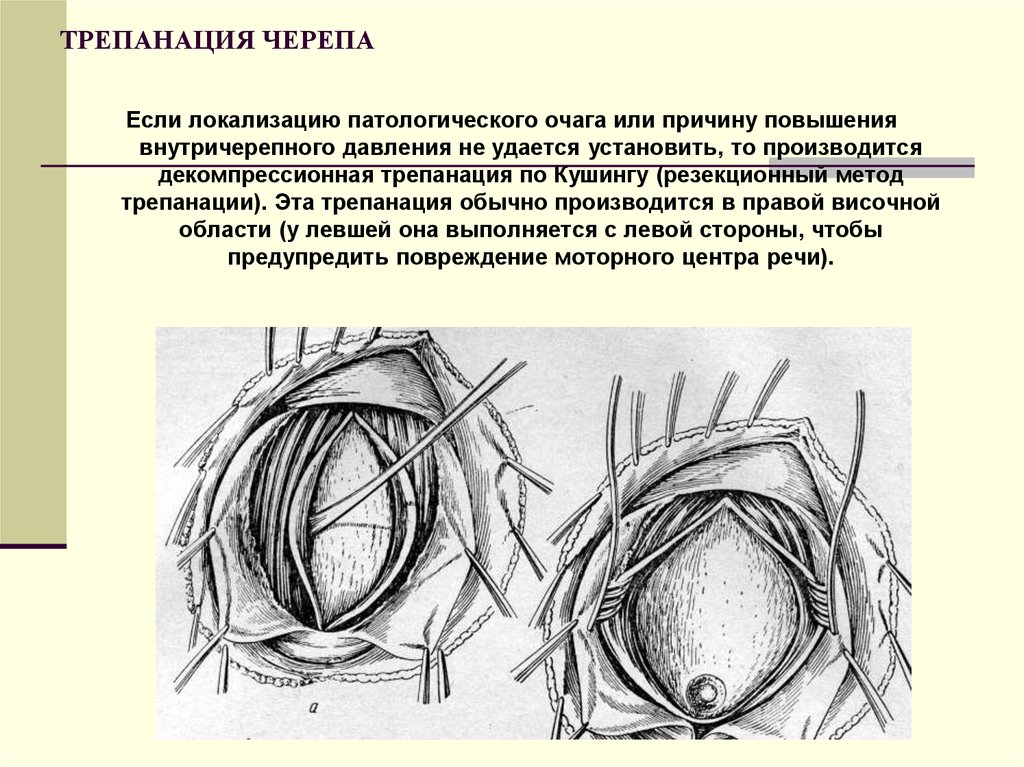 Костно пластическая трепанация черепа презентация