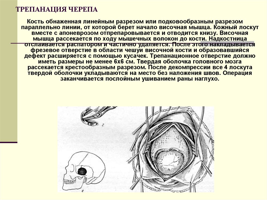 Способы трепанации. Костно-пластическая Трепанация черепа техника. Костно-пластическая Трепанация черепа осложнения. Эксплоративная Трепанация черепа. Кожно пластическая Трепанация черепа.