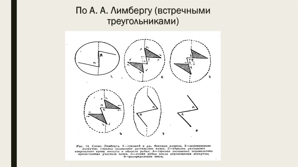 Пластика местными тканями презентация