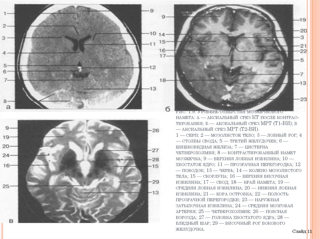 Мозжечок на кт. Аксиальный срез головного мозга мрт т2. Аксиальный срез кт. Аксиальные срезы головы кт. Протокол исследования головного мозга.