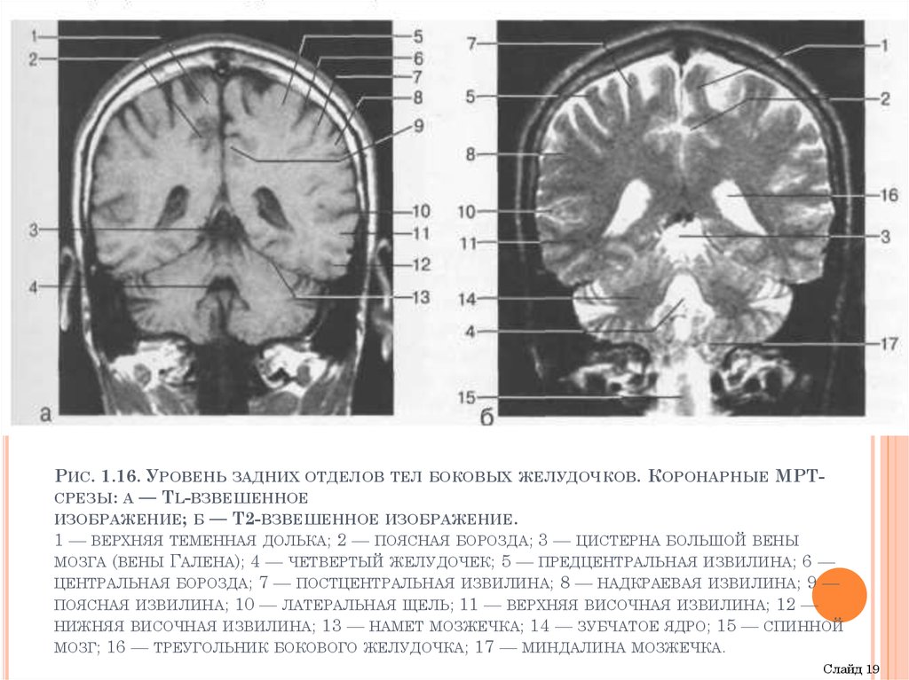 Мозжечок на кт. Анатомия головного мозга мрт сагиттальные срезы. Анатомия аксиальные срезы. Кт головного мозга аксиальный срез. Аксиальный коронарный Сагиттальный срез.