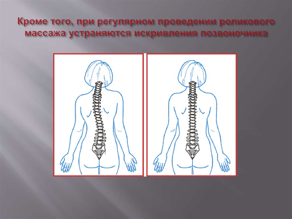 Регулярное проведение. Нарушение осанки по сколиотическому типу. Сколиотическая (асимметричная) осанка. Сколиотическая осанка характеризуется. Сколиотическая осанка поп.