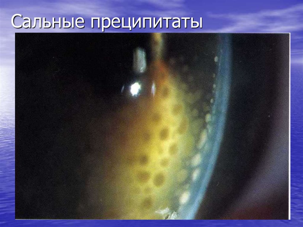 наличие преципитатов на эндотелии роговицы. звездчатые преципитаты. преципитаты на роговице. оптическая когерентная томография роговицы. преципитаты на роговице.