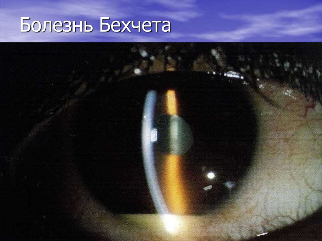 Болезнь Бехчета