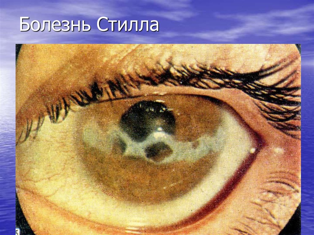 Болезнь Стилла