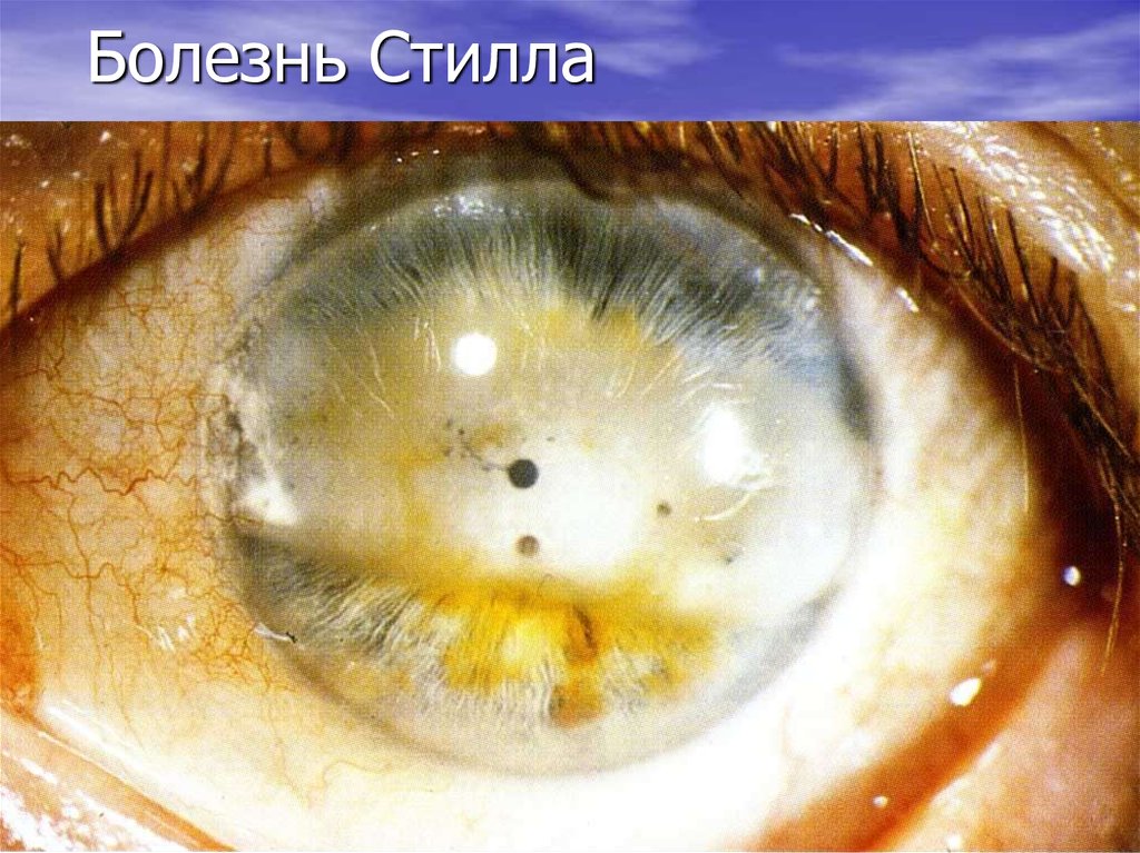 Болезнь Стилла