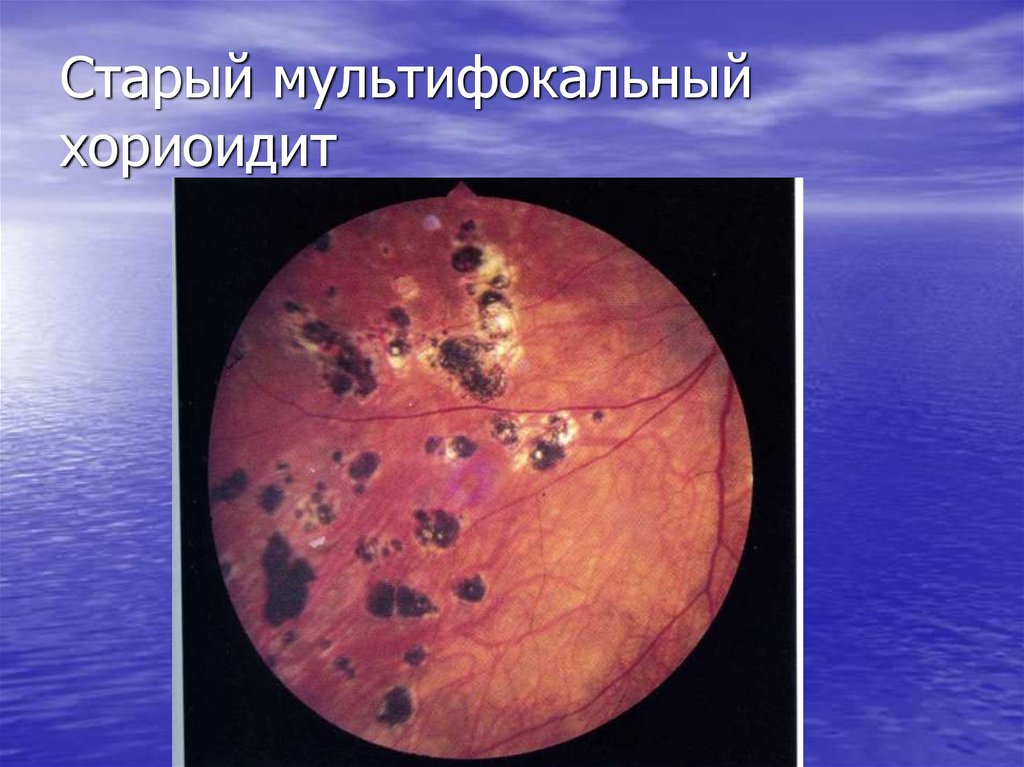 Старый мультифокальный хориоидит
