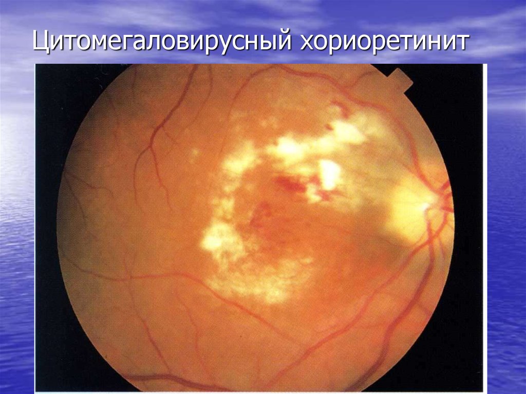 Цитомегаловирусный хориоретинит