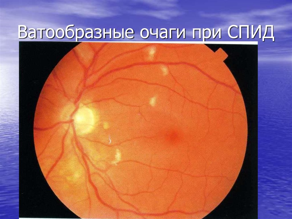 Ватообразные очаги при СПИД