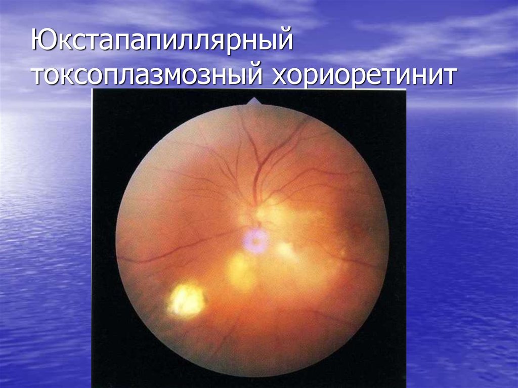 Юкстапапиллярный токсоплазмозный хориоретинит