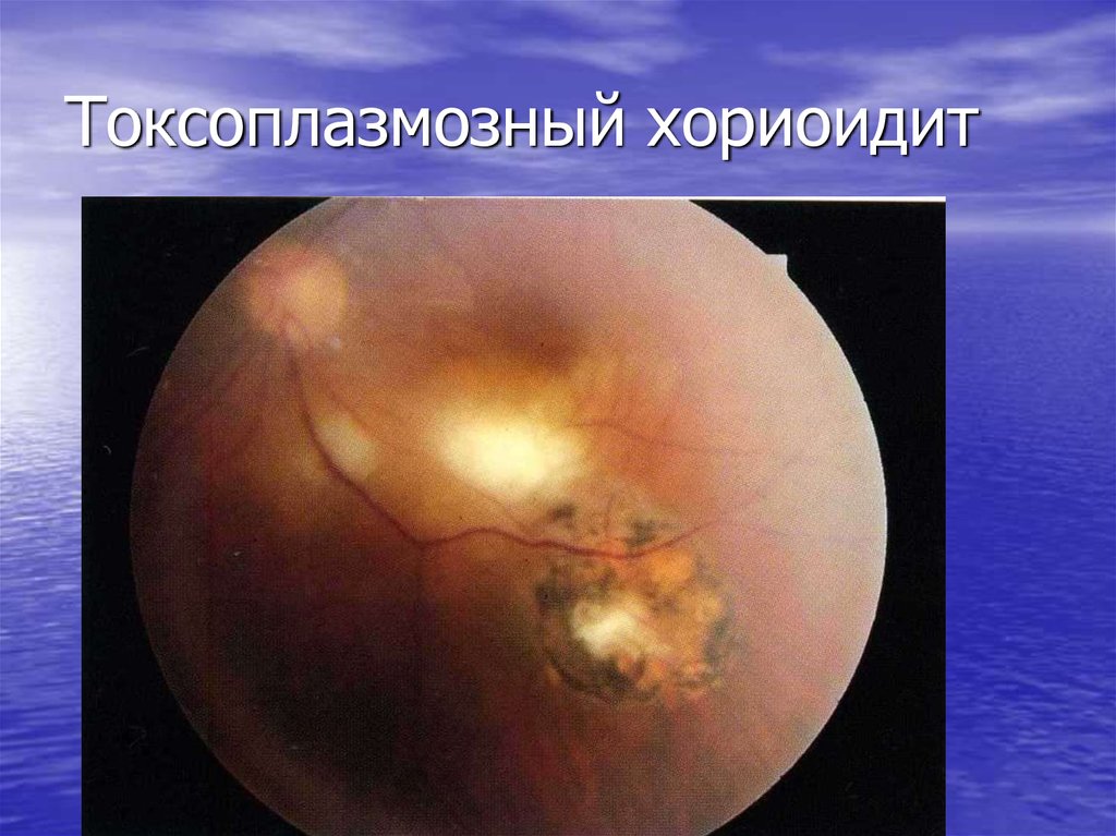 Токсоплазмозный хориоидит