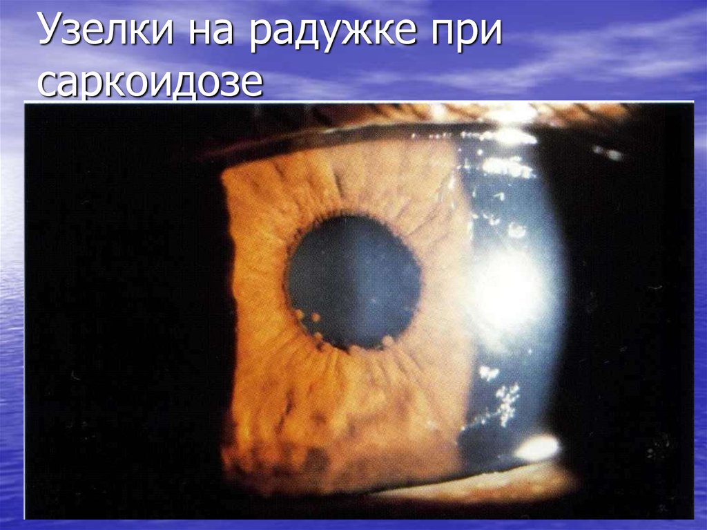 Узелки на радужке при саркоидозе