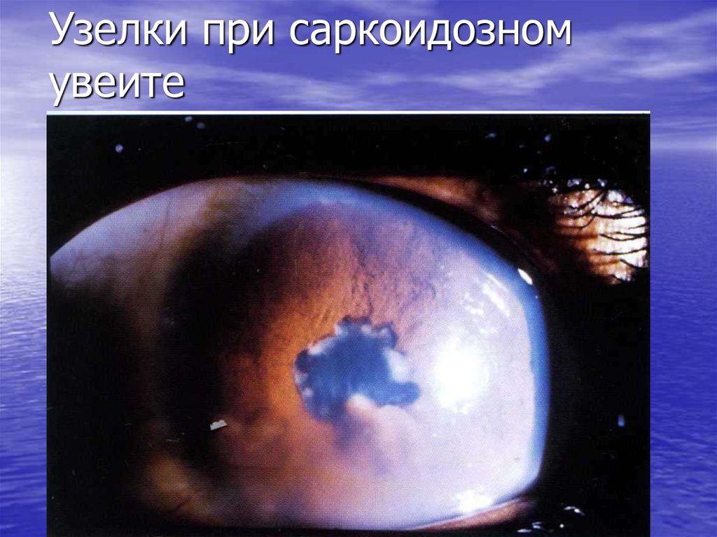 Узелки при саркоидозном увеите