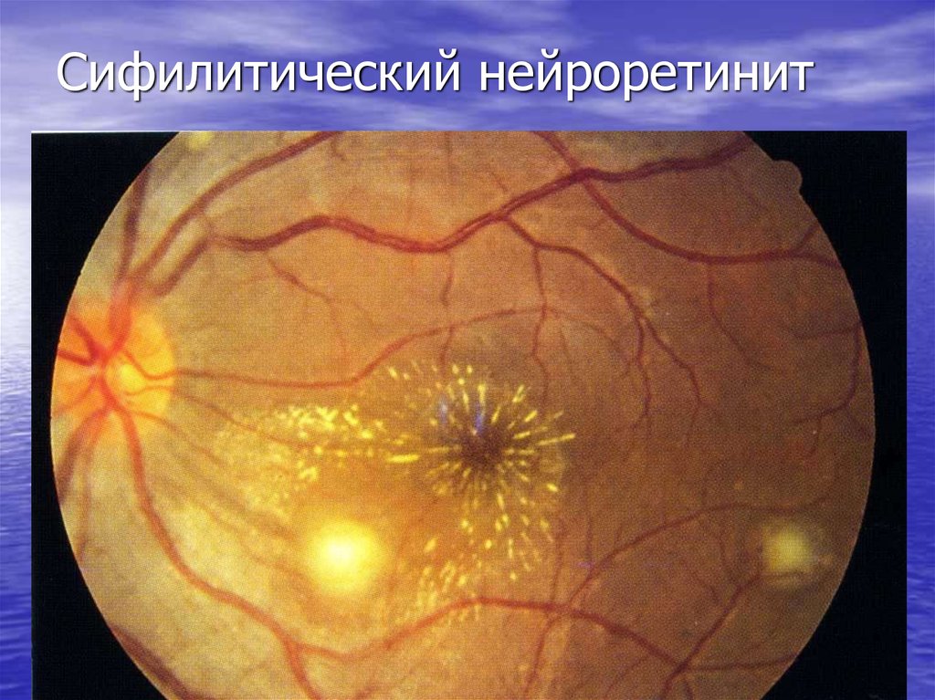 Сифилитический нейроретинит