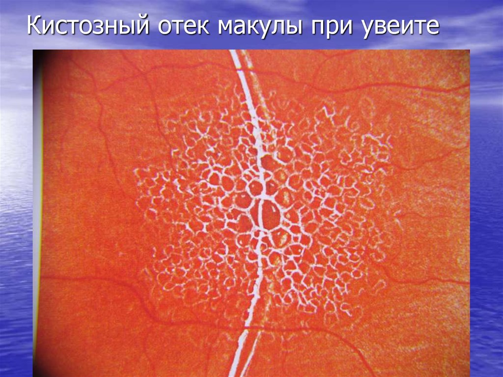 Кистозный отек макулы при увеите