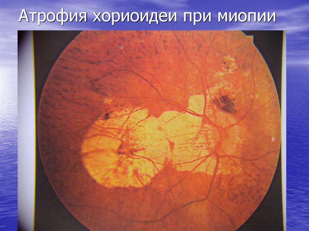 Атрофия хориоидеи при миопии