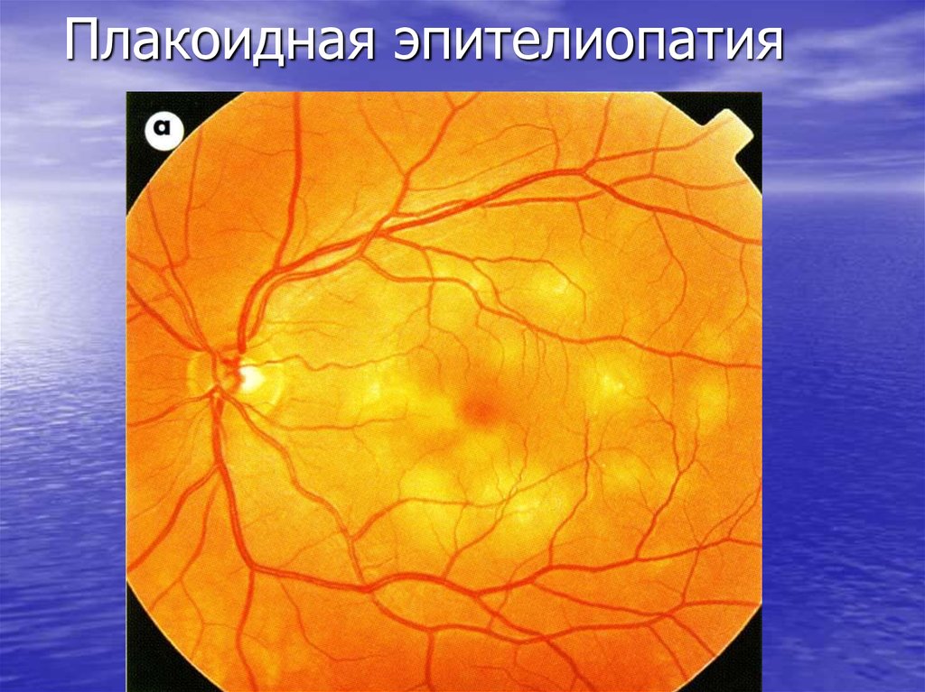 Плакоидная эпителиопатия