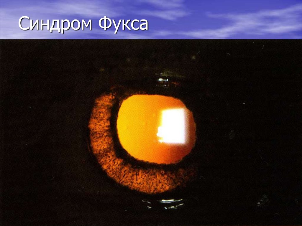 Синдром Фукса