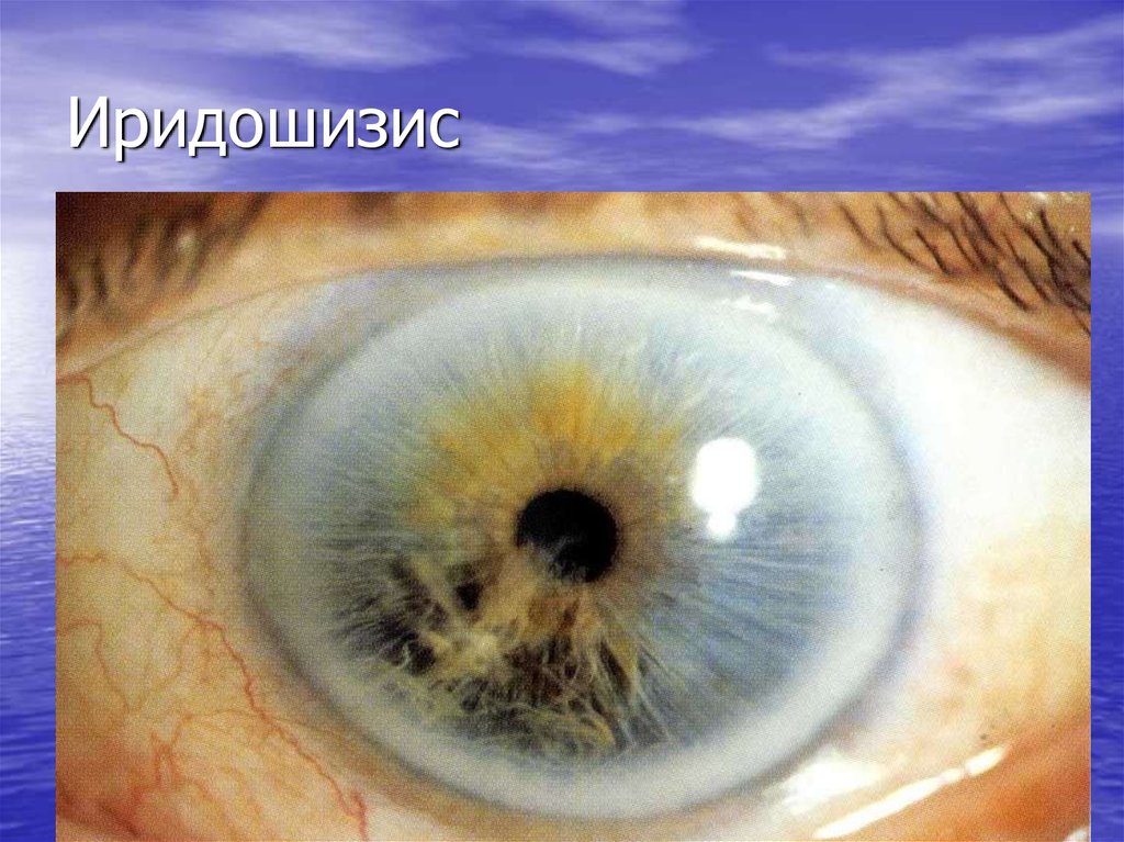 Иридошизис