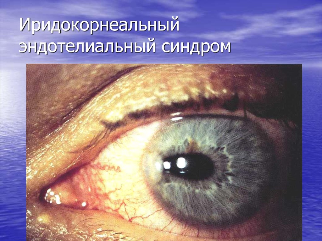 Иридокорнеальный эндотелиальный синдром
