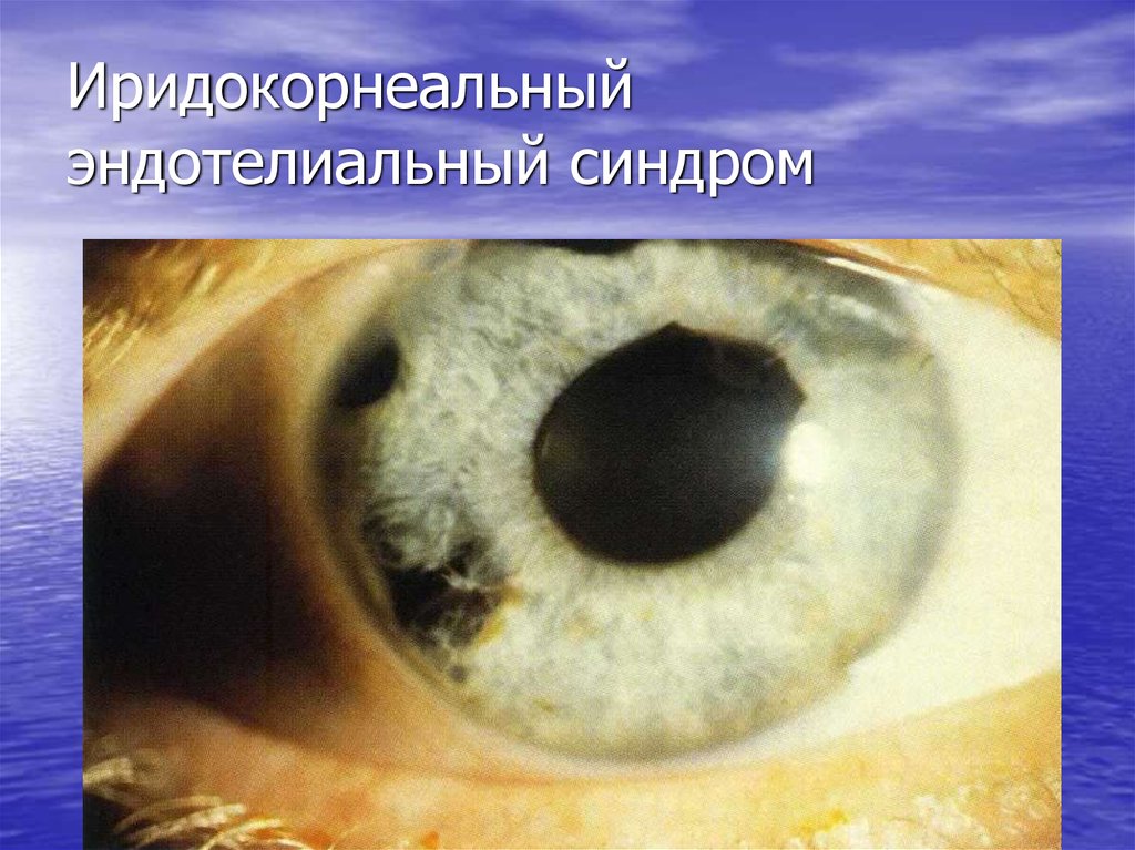 Иридокорнеальный эндотелиальный синдром