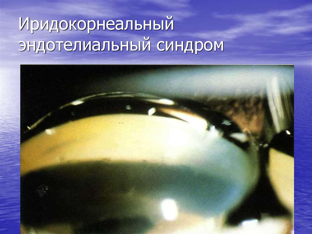 Иридокорнеальный эндотелиальный синдром